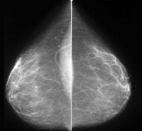 Tomosíntesis: el revolucionario método para la detección precoz del cáncer de mama